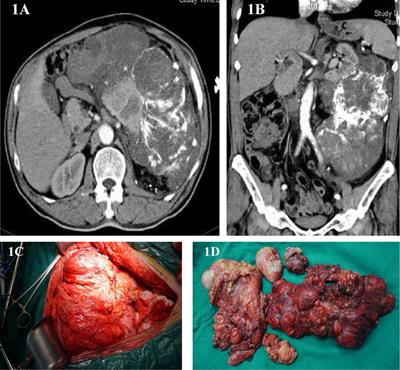 Case Report: Retroperitoneal Sarcoma in Six Operations: Our Experience in Operative Management of Blood Vessels